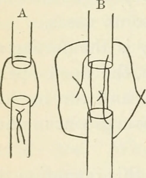 An illustration from A manual of modern surgery, general and operative : With 188 illus. in the text and 13 full-page plates in colors and tints, aggregating 276 separate figures., 1894, leaf 544