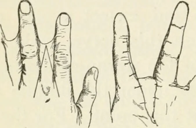 An illustration from A manual of modern surgery, general and operative : With 188 illus. in the text and 13 full-page plates in colors and tints, aggregating 276 separate figures., 1894, leaf 548