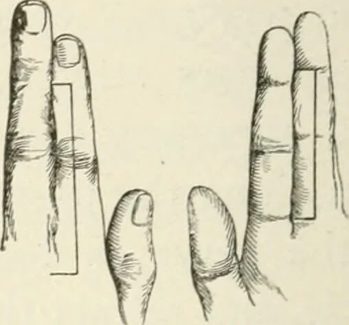 An illustration from A manual of modern surgery, general and operative : With 188 illus. in the text and 13 full-page plates in colors and tints, aggregating 276 separate figures., 1894, leaf 548