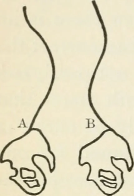 An illustration from A manual of modern surgery, general and operative : With 188 illus. in the text and 13 full-page plates in colors and tints, aggregating 276 separate figures., 1894, leaf 600