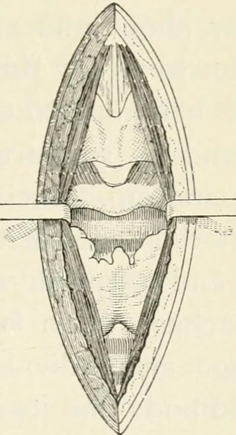An illustration from A manual of modern surgery, general and operative : With 188 illus. in the text and 13 full-page plates in colors and tints, aggregating 276 separate figures., 1894, leaf 617