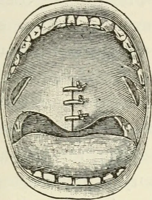 An illustration from A manual of modern surgery, general and operative : With 188 illus. in the text and 13 full-page plates in colors and tints, aggregating 276 separate figures., 1894, leaf 629