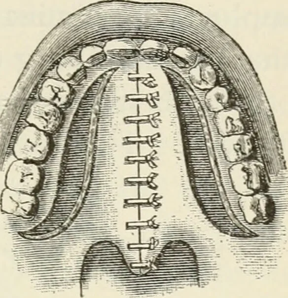 An illustration from A manual of modern surgery, general and operative : With 188 illus. in the text and 13 full-page plates in colors and tints, aggregating 276 separate figures., 1894, leaf 629