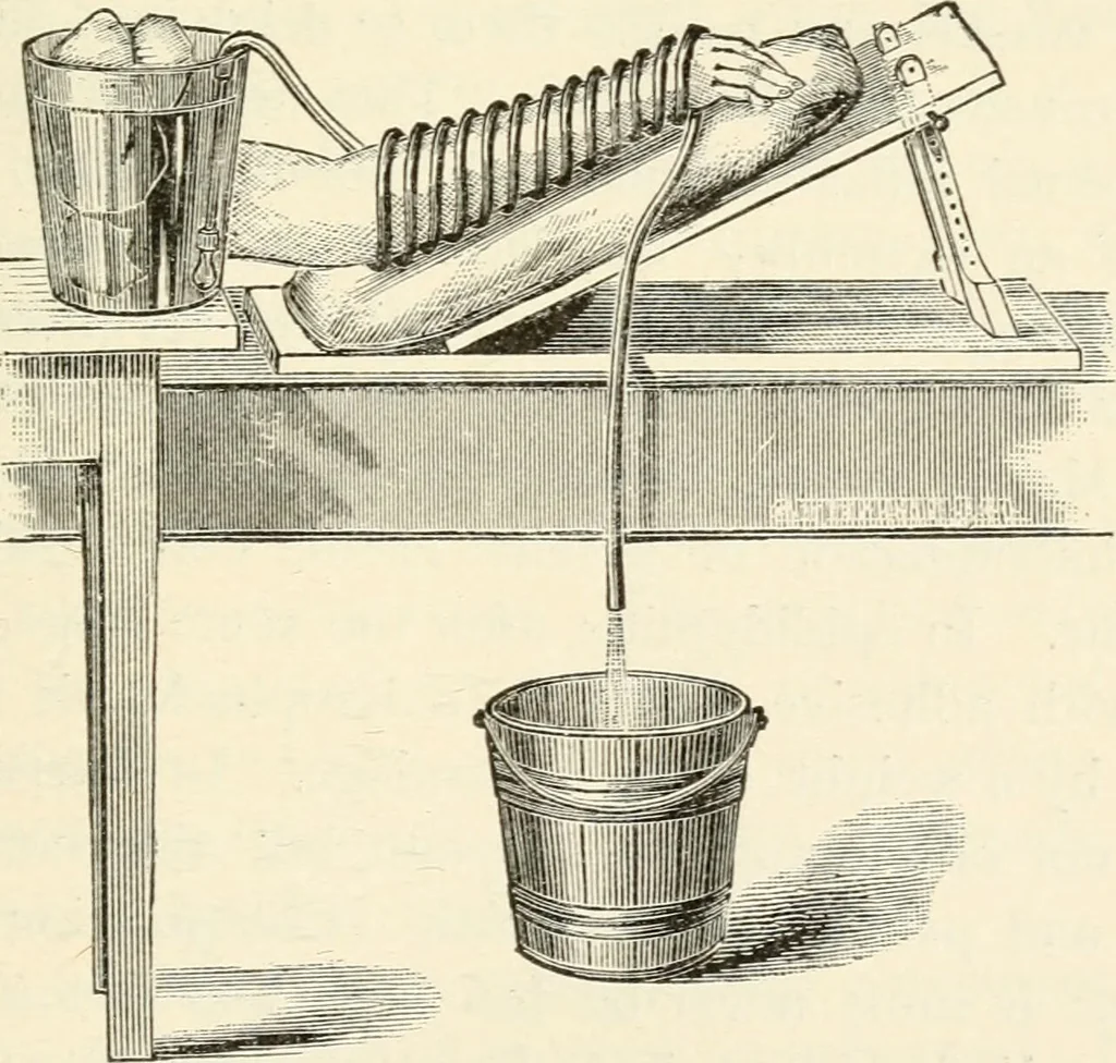 An illustration from A manual of modern surgery, general and operative : With 188 illus. in the text and 13 full-page plates in colors and tints, aggregating 276 separate figures., 1894, leaf 65