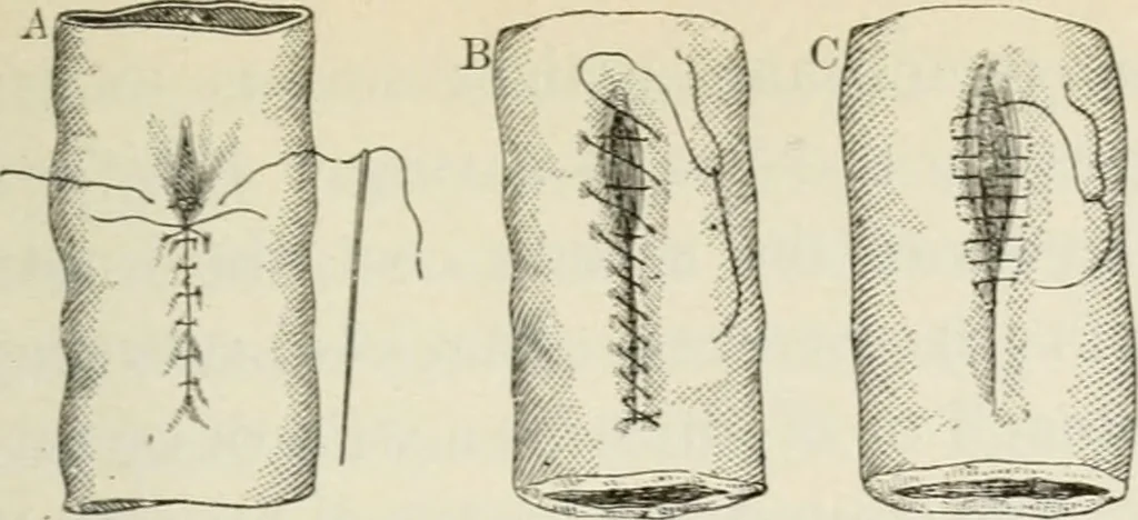 An illustration from A manual of modern surgery, general and operative : With 188 illus. in the text and 13 full-page plates in colors and tints, aggregating 276 separate figures., 1894, leaf 661