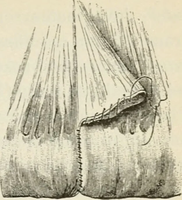 An illustration from A manual of modern surgery, general and operative : With 188 illus. in the text and 13 full-page plates in colors and tints, aggregating 276 separate figures., 1894, leaf 661