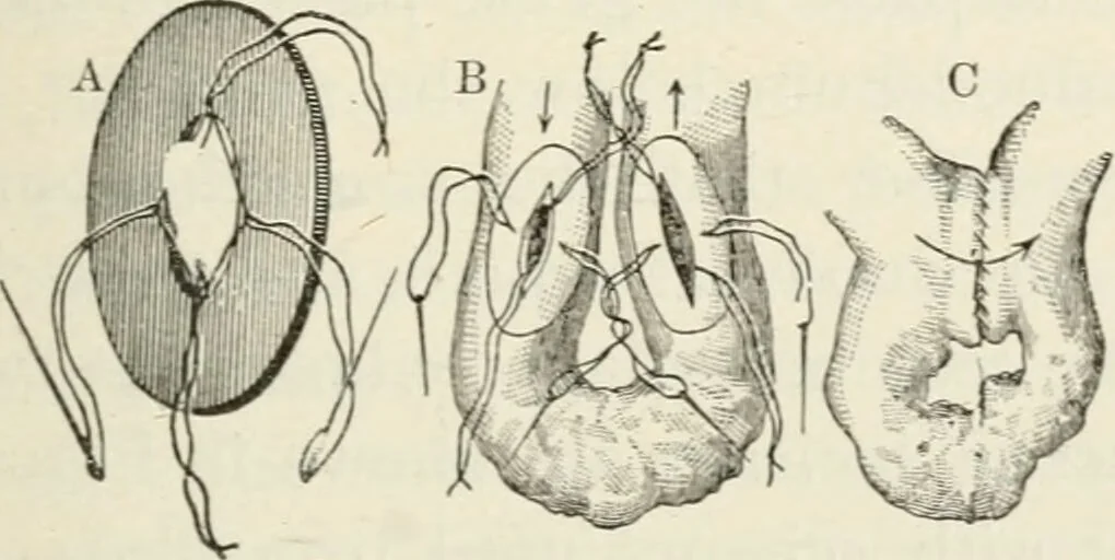 An illustration from A manual of modern surgery, general and operative : With 188 illus. in the text and 13 full-page plates in colors and tints, aggregating 276 separate figures., 1894, leaf 661