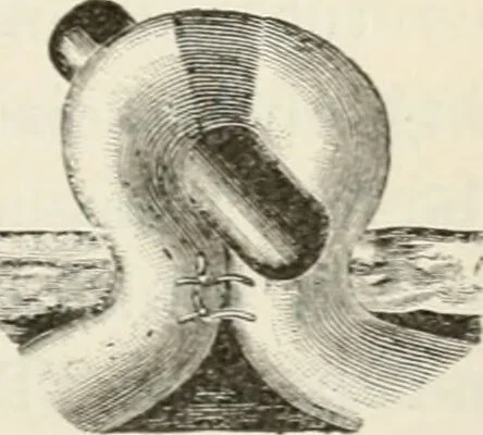 An illustration from A manual of modern surgery, general and operative : With 188 illus. in the text and 13 full-page plates in colors and tints, aggregating 276 separate figures., 1894, leaf 661