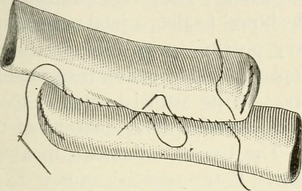 An illustration from A manual of modern surgery, general and operative : With 188 illus. in the text and 13 full-page plates in colors and tints, aggregating 276 separate figures., 1894, leaf 667