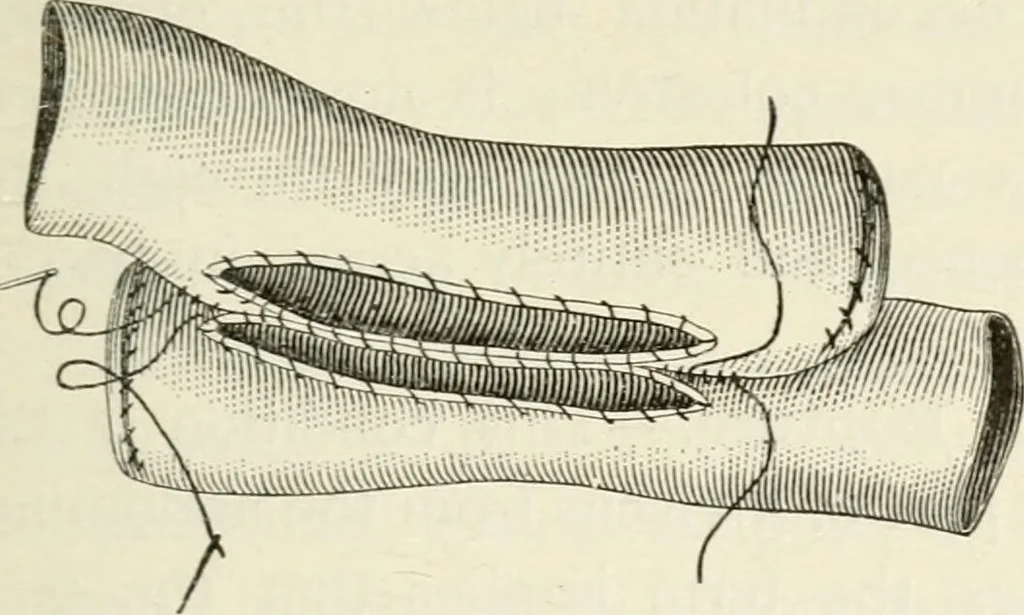 An illustration from A manual of modern surgery, general and operative : With 188 illus. in the text and 13 full-page plates in colors and tints, aggregating 276 separate figures., 1894, leaf 667