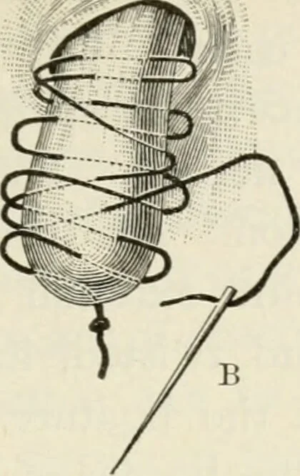 An illustration from A manual of modern surgery, general and operative : With 188 illus. in the text and 13 full-page plates in colors and tints, aggregating 276 separate figures., 1894, leaf 673