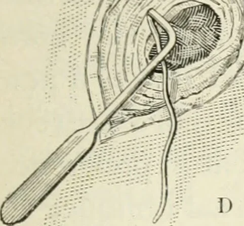 An illustration from A manual of modern surgery, general and operative : With 188 illus. in the text and 13 full-page plates in colors and tints, aggregating 276 separate figures., 1894, leaf 673