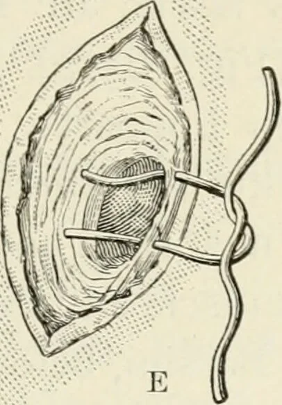 An illustration from A manual of modern surgery, general and operative : With 188 illus. in the text and 13 full-page plates in colors and tints, aggregating 276 separate figures., 1894, leaf 673