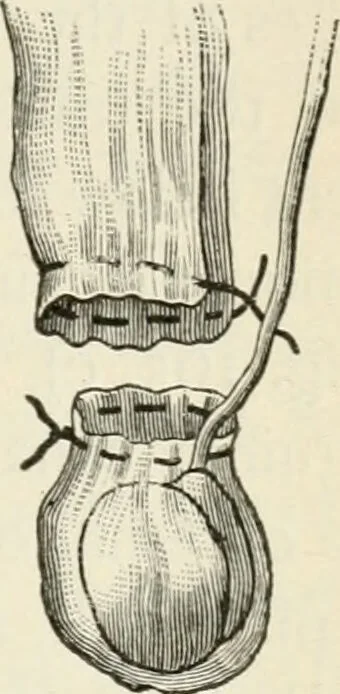 An illustration from A manual of modern surgery, general and operative : With 188 illus. in the text and 13 full-page plates in colors and tints, aggregating 276 separate figures., 1894, leaf 673
