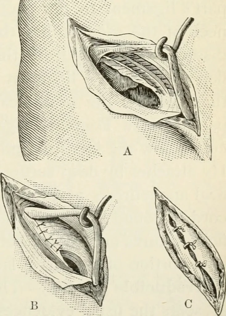 An illustration from A manual of modern surgery, general and operative : With 188 illus. in the text and 13 full-page plates in colors and tints, aggregating 276 separate figures., 1894, leaf 673