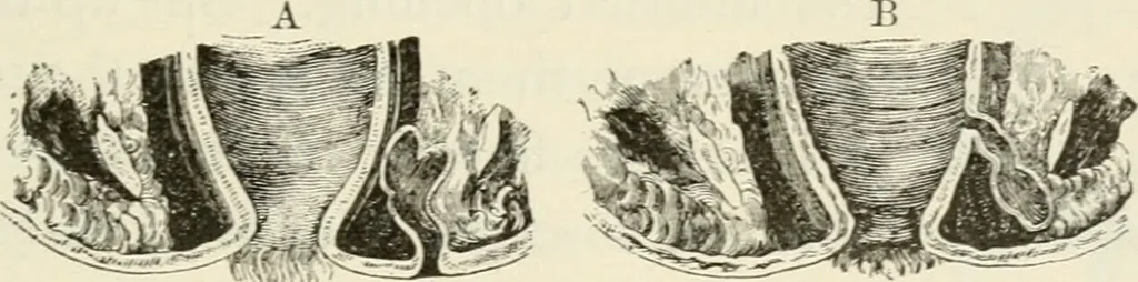An illustration from A manual of modern surgery, general and operative : With 188 illus. in the text and 13 full-page plates in colors and tints, aggregating 276 separate figures., 1894, leaf 691