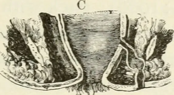 An illustration from A manual of modern surgery, general and operative : With 188 illus. in the text and 13 full-page plates in colors and tints, aggregating 276 separate figures., 1894, leaf 691