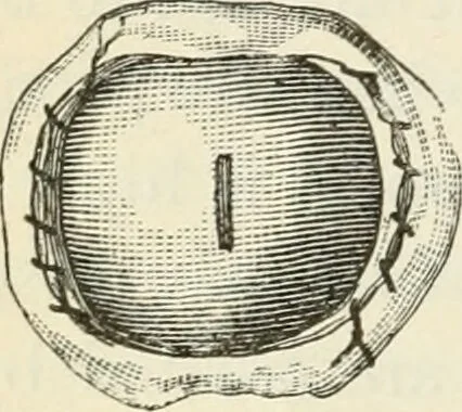 An illustration from A manual of modern surgery, general and operative : With 188 illus. in the text and 13 full-page plates in colors and tints, aggregating 276 separate figures., 1894, leaf 792