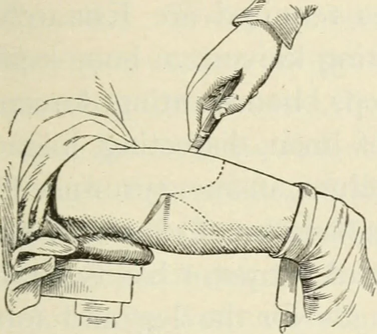 An illustration from A manual of modern surgery, general and operative : With 188 illus. in the text and 13 full-page plates in colors and tints, aggregating 276 separate figures., 1894, leaf 801