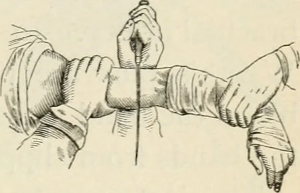 An illustration from A manual of modern surgery, general and operative : With 188 illus. in the text and 13 full-page plates in colors and tints, aggregating 276 separate figures., 1894, leaf 801