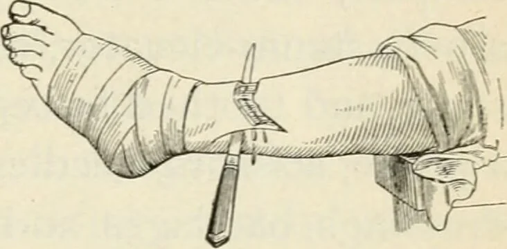 An illustration from A manual of modern surgery, general and operative : With 188 illus. in the text and 13 full-page plates in colors and tints, aggregating 276 separate figures., 1894, leaf 801