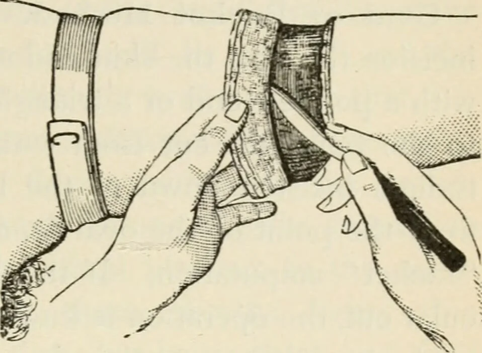 An illustration from A manual of modern surgery, general and operative : With 188 illus. in the text and 13 full-page plates in colors and tints, aggregating 276 separate figures., 1894, leaf 803