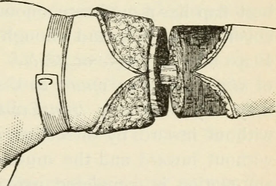 An illustration from A manual of modern surgery, general and operative : With 188 illus. in the text and 13 full-page plates in colors and tints, aggregating 276 separate figures., 1894, leaf 803