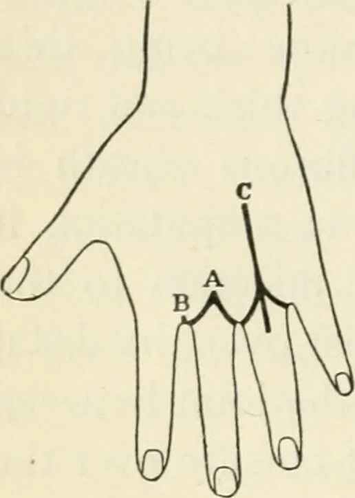An illustration from A manual of modern surgery, general and operative : With 188 illus. in the text and 13 full-page plates in colors and tints, aggregating 276 separate figures., 1894, leaf 806