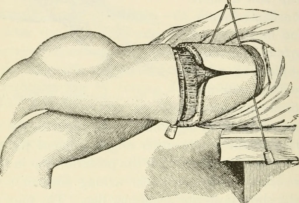 An illustration from A manual of modern surgery, general and operative : With 188 illus. in the text and 13 full-page plates in colors and tints, aggregating 276 separate figures., 1894, leaf 816