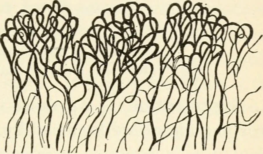 An illustration from A manual of modern surgery, general and operative : With 188 illus. in the text and 13 full-page plates in colors and tints, aggregating 276 separate figures., 1894, leaf 95