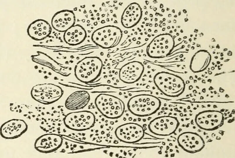 An illustration from A manual of modern surgery, general and operative : With 188 illus. in the text and 13 full-page plates in colors and tints, aggregating 276 separate figures., 1894, leaf 98