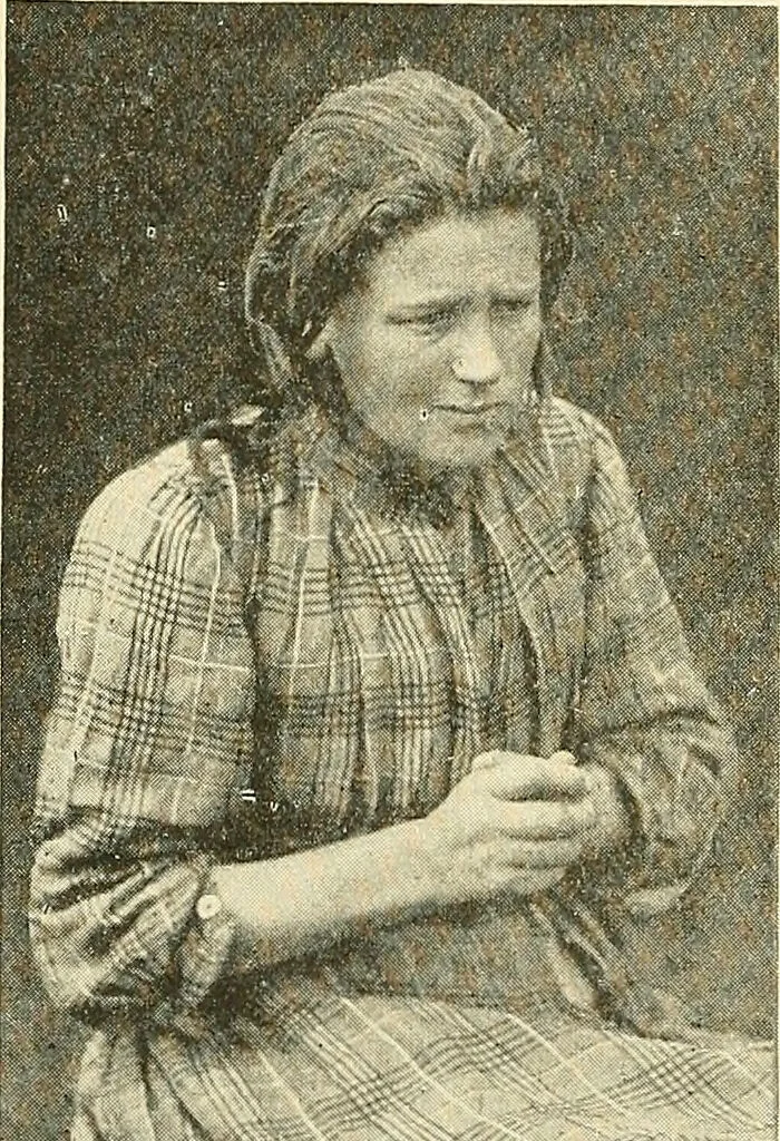 An illustration from Mental diseases : A text-book of psychiatry for medical students and practitioners / by R.H. Cole, ... With fifty-two illustrations and plates., 1913, leaf 128