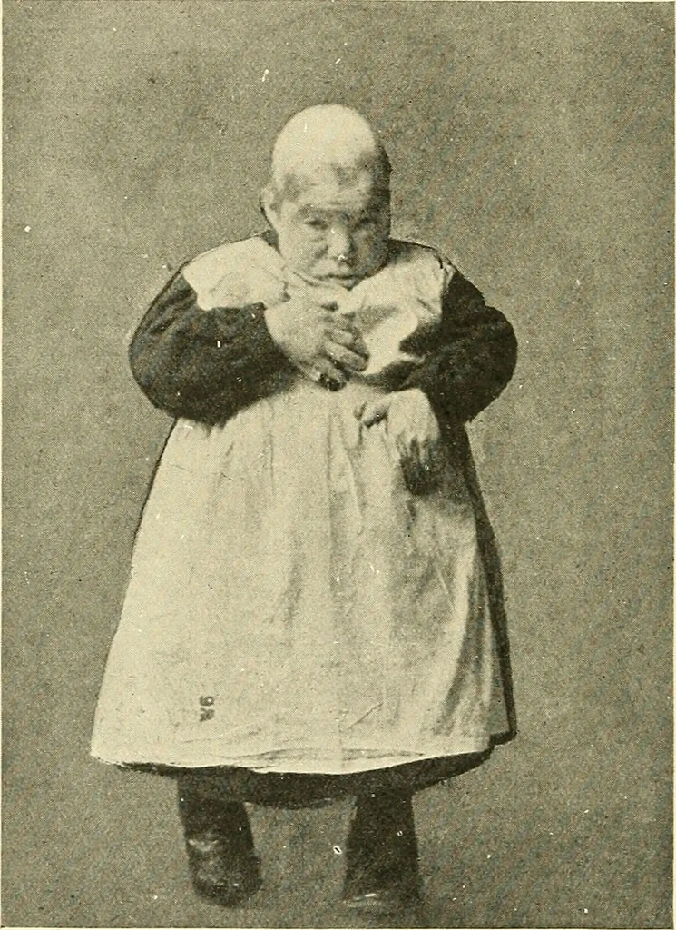 An illustration from Mental diseases : A text-book of psychiatry for medical students and practitioners / by R.H. Cole, ... With fifty-two illustrations and plates., 1913, leaf 170