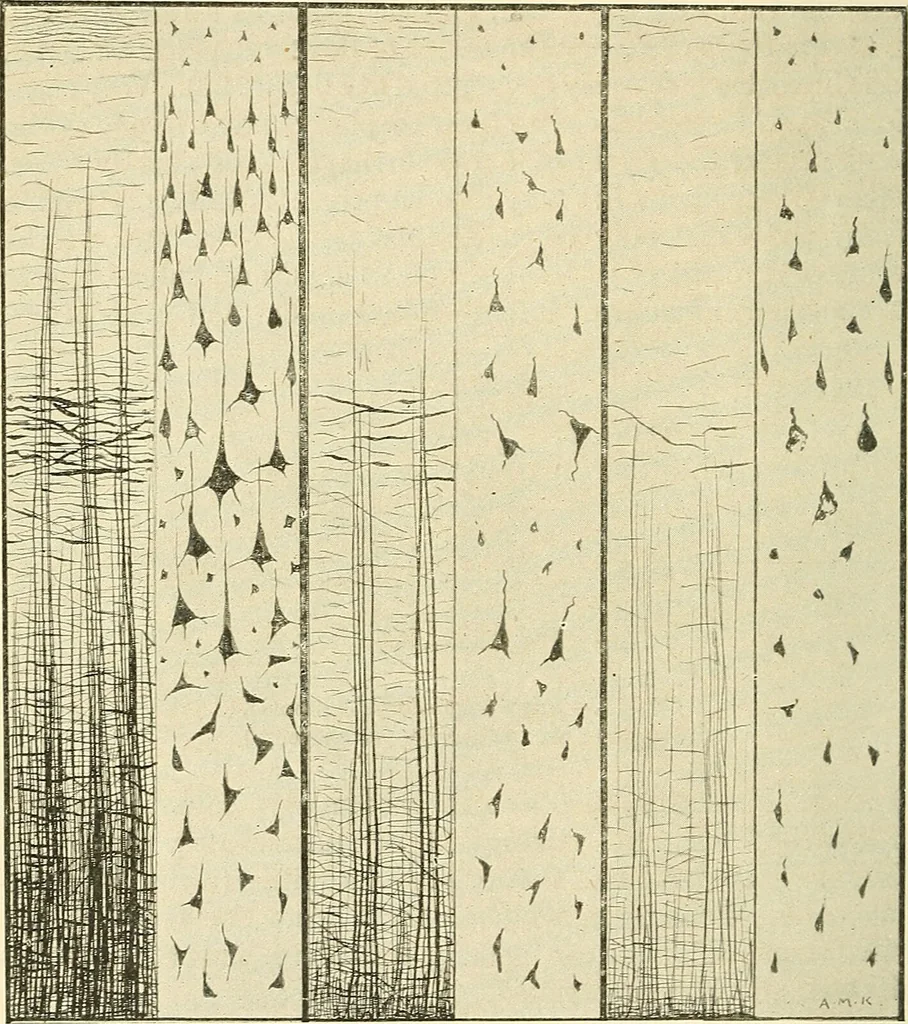 An illustration from Mental diseases : A text-book of psychiatry for medical students and practitioners / by R.H. Cole, ... With fifty-two illustrations and plates., 1913, leaf 262