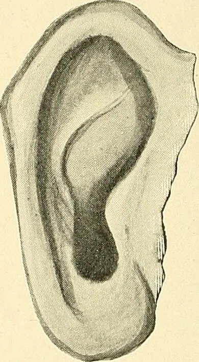An illustration from Mental diseases : A text-book of psychiatry for medical students and practitioners / by R.H. Cole, ... With fifty-two illustrations and plates., 1913, leaf 284