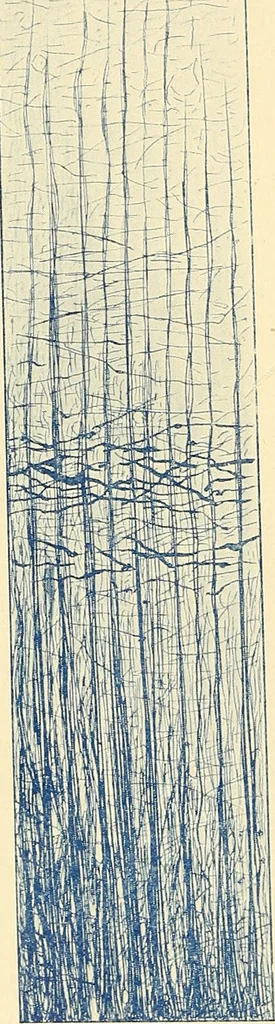 An illustration from Mental diseases : A text-book of psychiatry for medical students and practitioners / by R.H. Cole, ... With fifty-two illustrations and plates., 1913, leaf 46