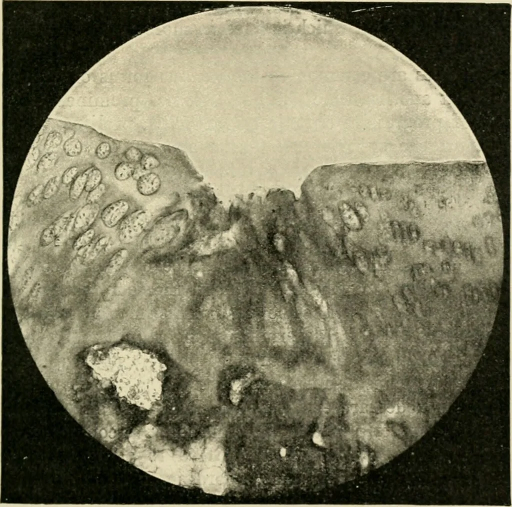 An illustration from Diseases of metabolism and of the blood : animal parasites, toxicology / ed. by Richard C. Cabot ... An authorized translation from "Die deutsche klinik" under the general editorial supervision of Julius L. Salinger, M. D. With one colored plate and fifty-eight illustrations in the text., 1906, leaf 269