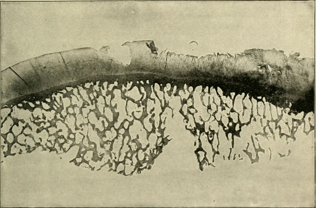An illustration from Diseases of metabolism and of the blood : animal parasites, toxicology / ed. by Richard C. Cabot ... An authorized translation from "Die deutsche klinik" under the general editorial supervision of Julius L. Salinger, M. D. With one colored plate and fifty-eight illustrations in the text., 1906, leaf 273