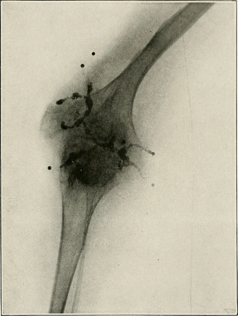 An illustration from Bismuth paste in chronic suppurations : its diagnostic importance and therapeutic value / by Emil G. Beck ... with an introduction by Carl Beck, M. D., and a chapter on the application of bismuth paste in the treatment of chronic suppuration of the nasal accessory sinuses and the ear, by Joseph C. Beck, M. D. With eighty-one engravings, nine diagrammatic illustrations, and a colored plate., 1914, leaf 105
