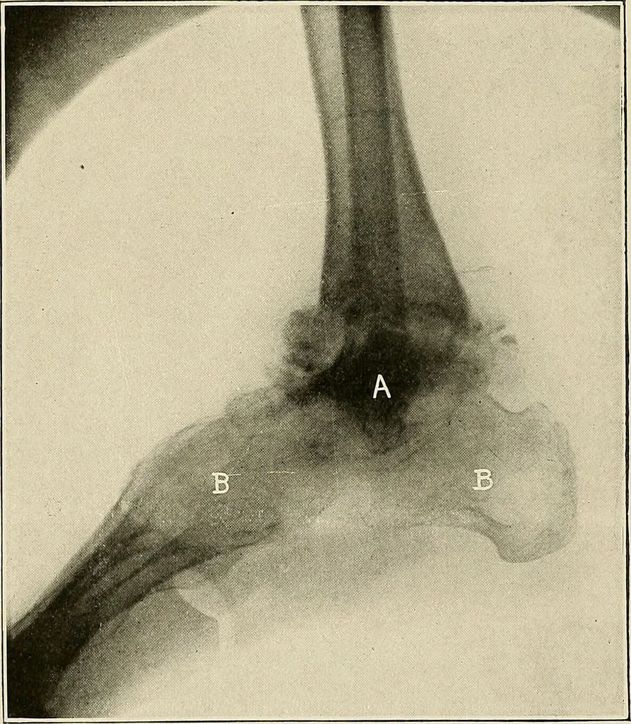 An illustration from Bismuth paste in chronic suppurations : its diagnostic importance and therapeutic value / by Emil G. Beck ... with an introduction by Carl Beck, M. D., and a chapter on the application of bismuth paste in the treatment of chronic suppuration of the nasal accessory sinuses and the ear, by Joseph C. Beck, M. D. With eighty-one engravings, nine diagrammatic illustrations, and a colored plate., 1914, leaf 108