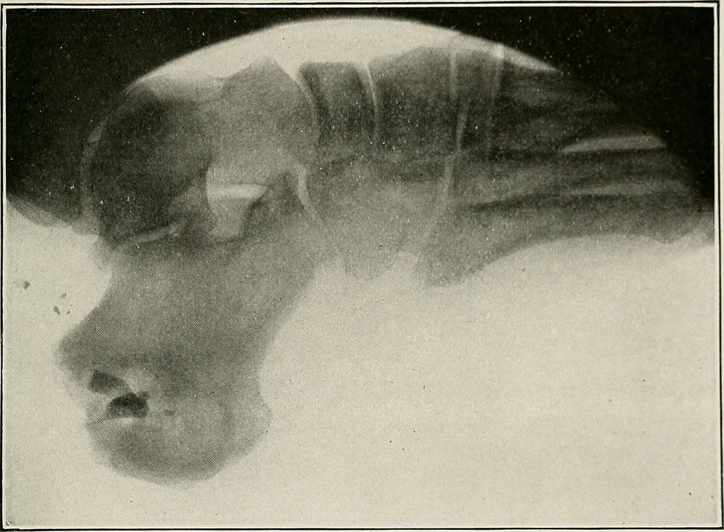 An illustration from Bismuth paste in chronic suppurations : its diagnostic importance and therapeutic value / by Emil G. Beck ... with an introduction by Carl Beck, M. D., and a chapter on the application of bismuth paste in the treatment of chronic suppuration of the nasal accessory sinuses and the ear, by Joseph C. Beck, M. D. With eighty-one engravings, nine diagrammatic illustrations, and a colored plate., 1914, leaf 109
