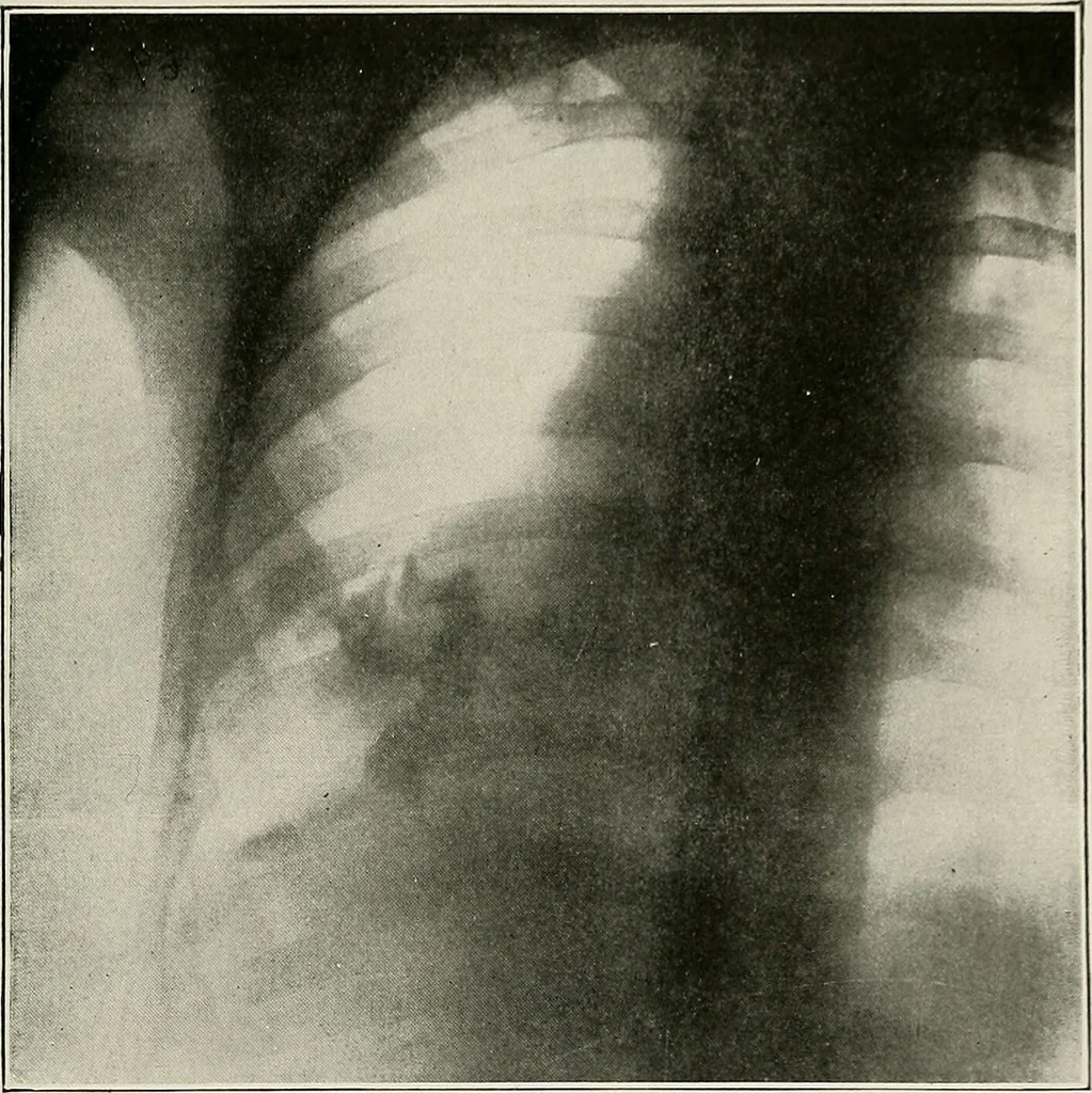 An illustration from Bismuth paste in chronic suppurations : its diagnostic importance and therapeutic value / by Emil G. Beck ... with an introduction by Carl Beck, M. D., and a chapter on the application of bismuth paste in the treatment of chronic suppuration of the nasal accessory sinuses and the ear, by Joseph C. Beck, M. D. With eighty-one engravings, nine diagrammatic illustrations, and a colored plate., 1914, leaf 111