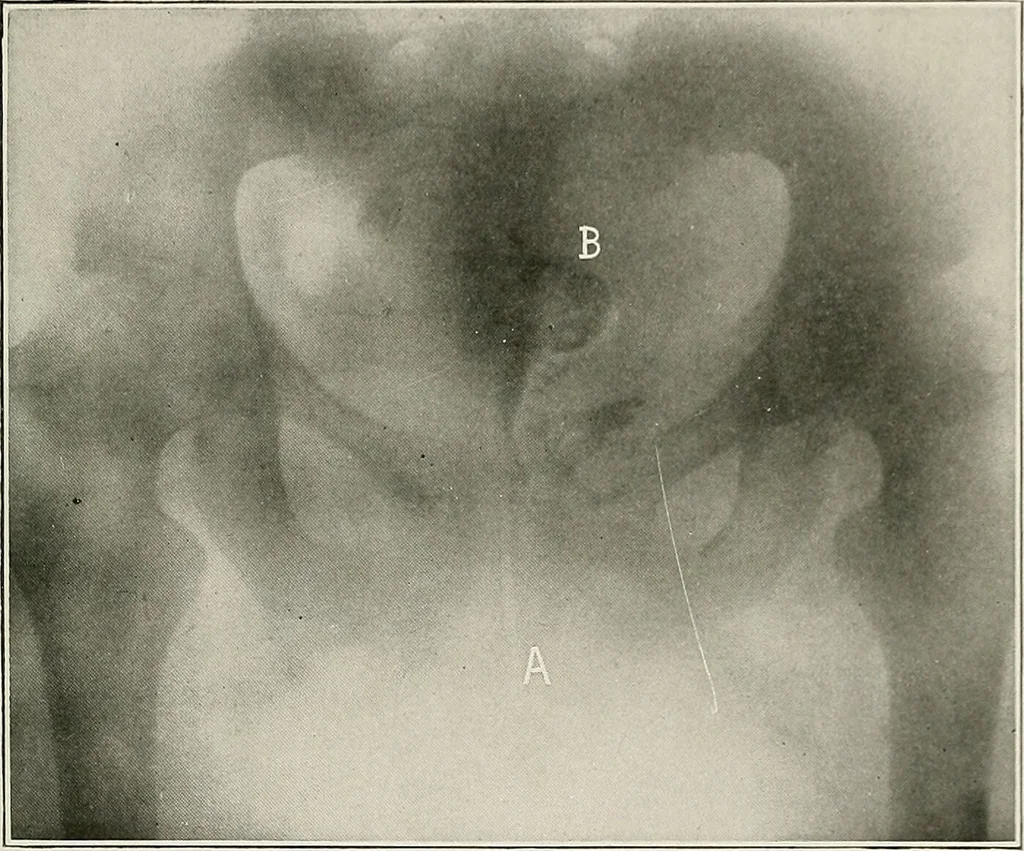 An illustration from Bismuth paste in chronic suppurations : its diagnostic importance and therapeutic value / by Emil G. Beck ... with an introduction by Carl Beck, M. D., and a chapter on the application of bismuth paste in the treatment of chronic suppuration of the nasal accessory sinuses and the ear, by Joseph C. Beck, M. D. With eighty-one engravings, nine diagrammatic illustrations, and a colored plate., 1914, leaf 133