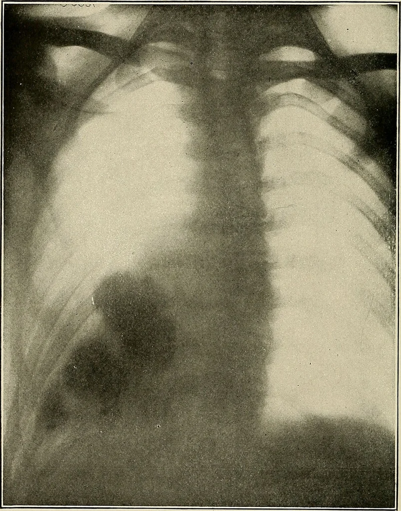 An illustration from Bismuth paste in chronic suppurations : its diagnostic importance and therapeutic value / by Emil G. Beck ... with an introduction by Carl Beck, M. D., and a chapter on the application of bismuth paste in the treatment of chronic suppuration of the nasal accessory sinuses and the ear, by Joseph C. Beck, M. D. With eighty-one engravings, nine diagrammatic illustrations, and a colored plate., 1914, leaf 154