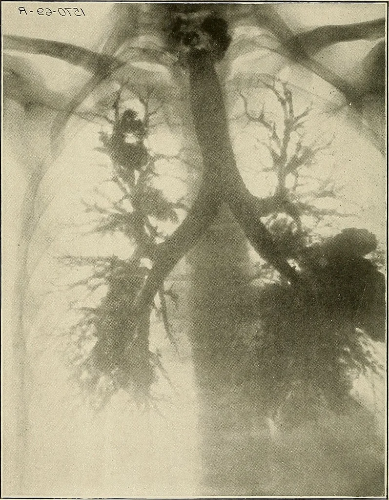An illustration from Bismuth paste in chronic suppurations : its diagnostic importance and therapeutic value / by Emil G. Beck ... with an introduction by Carl Beck, M. D., and a chapter on the application of bismuth paste in the treatment of chronic suppuration of the nasal accessory sinuses and the ear, by Joseph C. Beck, M. D. With eighty-one engravings, nine diagrammatic illustrations, and a colored plate., 1914, leaf 156