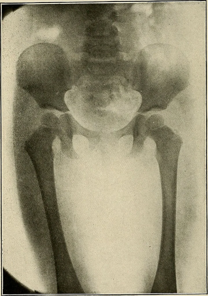 An illustration from Bismuth paste in chronic suppurations : its diagnostic importance and therapeutic value / by Emil G. Beck ... with an introduction by Carl Beck, M. D., and a chapter on the application of bismuth paste in the treatment of chronic suppuration of the nasal accessory sinuses and the ear, by Joseph C. Beck, M. D. With eighty-one engravings, nine diagrammatic illustrations, and a colored plate., 1914, leaf 166