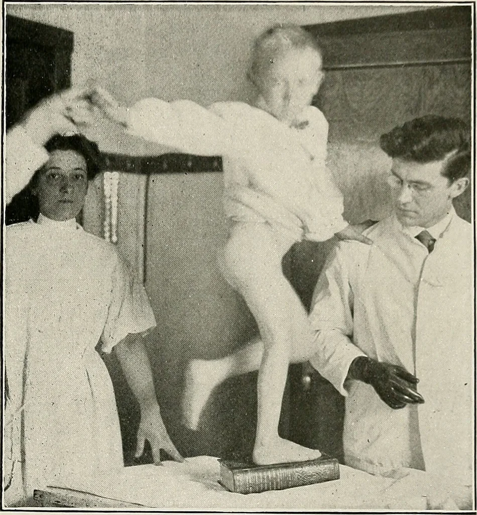 An illustration from Bismuth paste in chronic suppurations : its diagnostic importance and therapeutic value / by Emil G. Beck ... with an introduction by Carl Beck, M. D., and a chapter on the application of bismuth paste in the treatment of chronic suppuration of the nasal accessory sinuses and the ear, by Joseph C. Beck, M. D. With eighty-one engravings, nine diagrammatic illustrations, and a colored plate., 1914, leaf 167