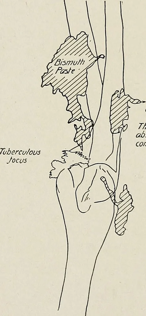 An illustration from Bismuth paste in chronic suppurations : its diagnostic importance and therapeutic value / by Emil G. Beck ... with an introduction by Carl Beck, M. D., and a chapter on the application of bismuth paste in the treatment of chronic suppuration of the nasal accessory sinuses and the ear, by Joseph C. Beck, M. D. With eighty-one engravings, nine diagrammatic illustrations, and a colored plate., 1914, leaf 171