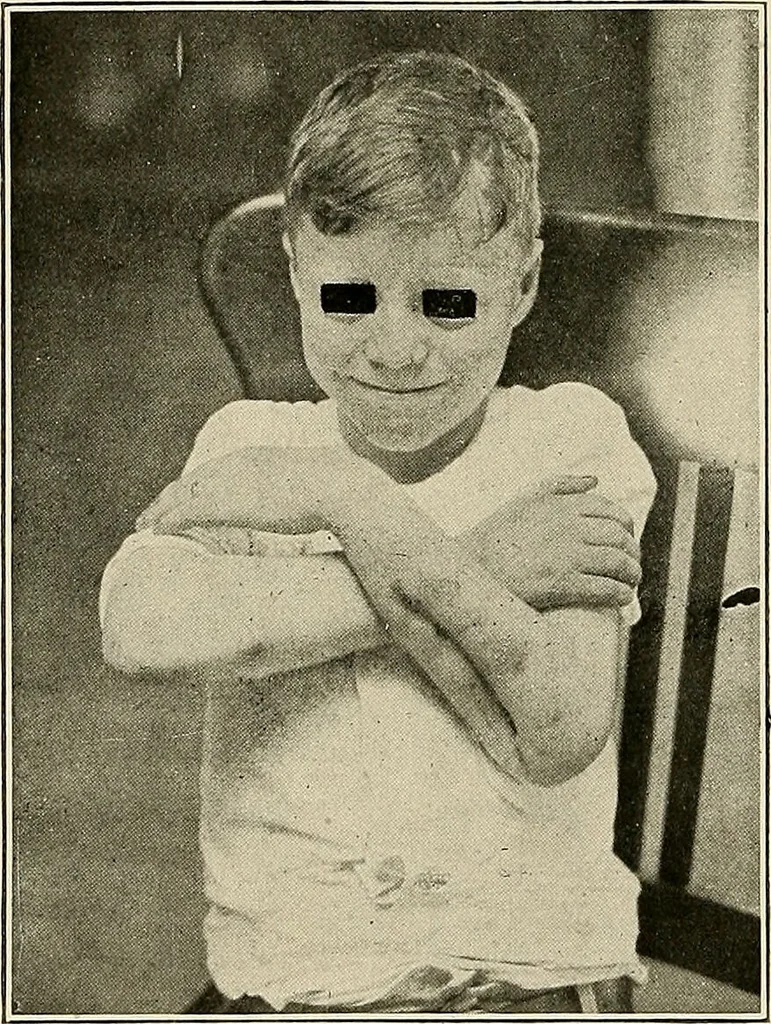 An illustration from Bismuth paste in chronic suppurations : its diagnostic importance and therapeutic value / by Emil G. Beck ... with an introduction by Carl Beck, M. D., and a chapter on the application of bismuth paste in the treatment of chronic suppuration of the nasal accessory sinuses and the ear, by Joseph C. Beck, M. D. With eighty-one engravings, nine diagrammatic illustrations, and a colored plate., 1914, leaf 180