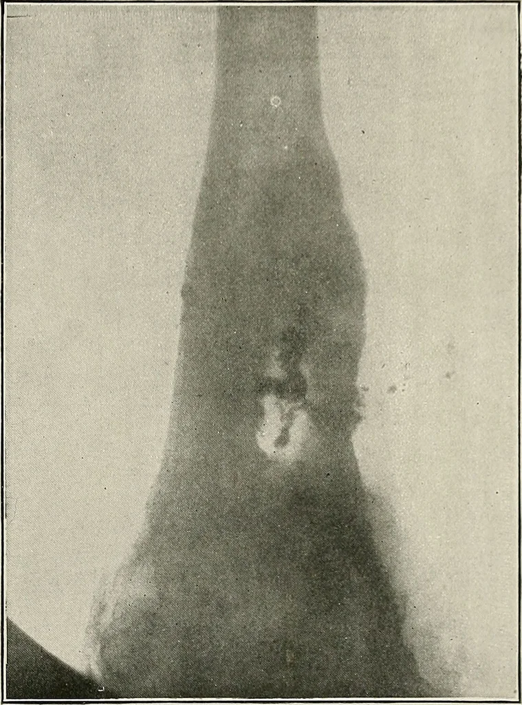 An illustration from Bismuth paste in chronic suppurations : its diagnostic importance and therapeutic value / by Emil G. Beck ... with an introduction by Carl Beck, M. D., and a chapter on the application of bismuth paste in the treatment of chronic suppuration of the nasal accessory sinuses and the ear, by Joseph C. Beck, M. D. With eighty-one engravings, nine diagrammatic illustrations, and a colored plate., 1914, leaf 181